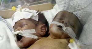 Необычные Сиамские близнецы родились в Йемене