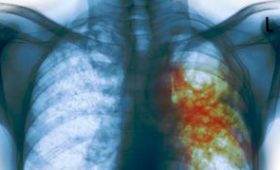 Ученые: вылечить туберкулез возможно с помощью витамина D